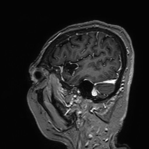 Cavernous hemangioma of the cerebellar falx (Radiopaedia 73025-83724 Sagittal T1 C+ 37).jpg