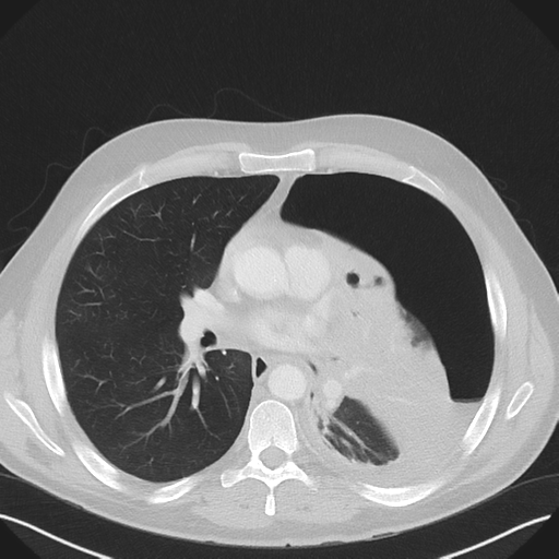 File:Cavitating pneumonia complicated by pneumothorax (Radiopaedia 48149-52994 Axial lung window 35).png