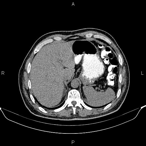 Cecal adenocarcinoma (Radiopaedia 85324-100916 Axial non-contrast 17).jpg