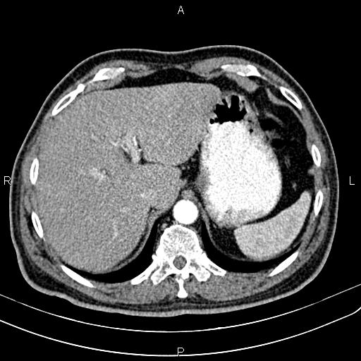 Cecal cancer with appendiceal mucocele (Radiopaedia 91080-108651 A 60).jpg