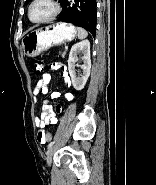 File:Cecal cancer with appendiceal mucocele (Radiopaedia 91080-108651 E 70).jpg