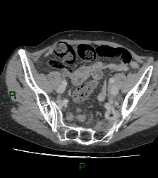 Cecal volvulus (Radiopaedia 86741-102900 A 104).jpg