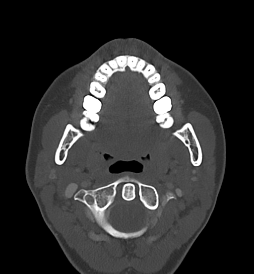 Cemento-ossifying fibroma (Radiopaedia 46243-50643 Axial bone window 36).png
