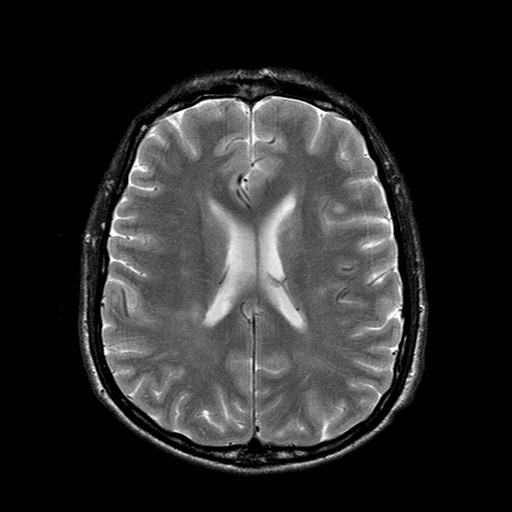 File:Central-variant posterior reversible encephalopathy syndrome (PRES) (Radiopaedia 43880-47358 Axial T2 15).jpg