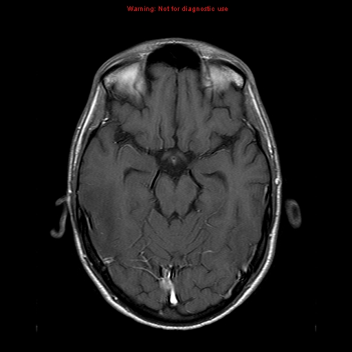 File:Central nervous system vasculitis (Radiopaedia 8410-9235 Axial T1 C+ 9).jpg