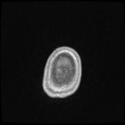 Central neurocytoma (Radiopaedia 30220-30842 Axial T1 C+ 148).jpg