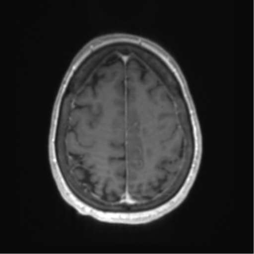 Central neurocytoma (Radiopaedia 65317-74345 Axial T1 C+ 48).png