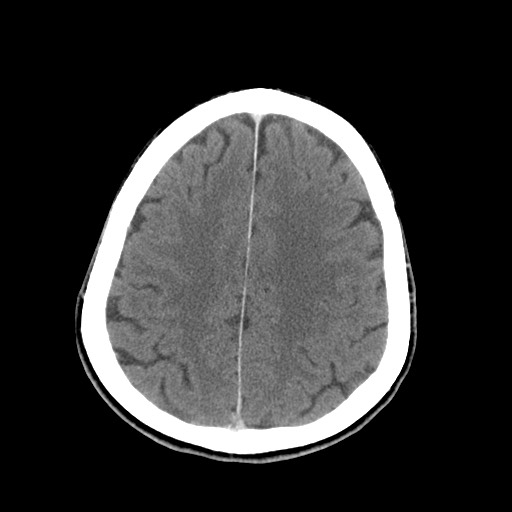 Central neurocytoma (Radiopaedia 68725-78432 Axial C+ 70).jpg