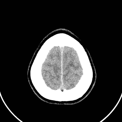 Central neurocytoma (Radiopaedia 84497-99871 Axial non-contrast 48).jpg