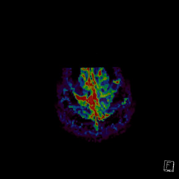 Central neurocytoma (Radiopaedia 84497-99872 Axial Perfusion 14).jpg