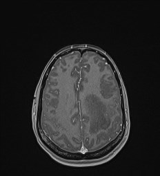 Central neurocytoma (Radiopaedia 84497-99872 Axial T1 C+ 115).jpg