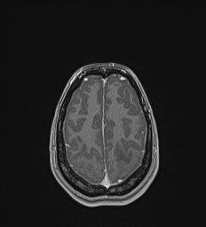 Central neurocytoma (Radiopaedia 84497-99872 Axial T1 C+ 128).jpg
