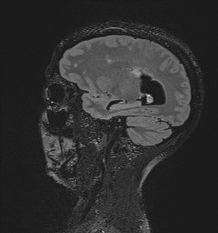 File:Central neurocytoma (Radiopaedia 84497-99872 Sagittal Flair + Gd 50).jpg