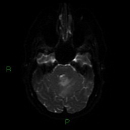 Cerebellar abscess (Radiopaedia 78135-90678 Axial DWI 40).jpg