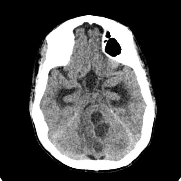 File:Cerebellar abscess secondary to mastoiditis (Radiopaedia 26284-26412 Axial non-contrast 54).jpg