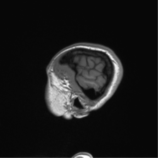 Cerebellar agenesis with hypoplastic pons (pontocerebellar hypoplasia) (Radiopaedia 57224-64138 Sagittal T1 58).png