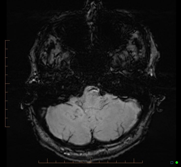 Cerebellar gangliocytoma (Radiopaedia 65377-74422 Axial SWI 10).jpg