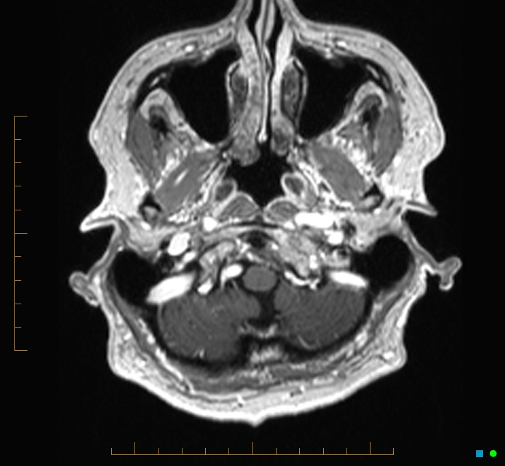 Cerebellar gangliocytoma (Radiopaedia 65377-74422 Axial T1 C+ 2).jpg