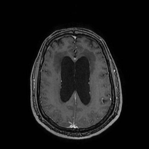 File:Cerebellar hemangioblastoma (Radiopaedia 88055-104622 Axial T1 C+ 119).jpg
