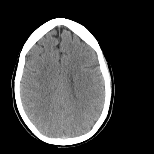 File:Cerebellar infarct due to vertebral artery dissection with posterior fossa decompression (Radiopaedia 82779-97029 Axial non-contrast 19).png