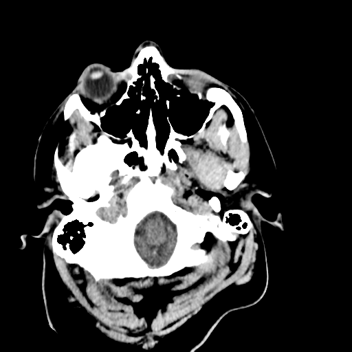 File:Cerebellar infarct due to vertebral artery dissection with posterior fossa decompression (Radiopaedia 82779-97029 Axial non-contrast 2).png