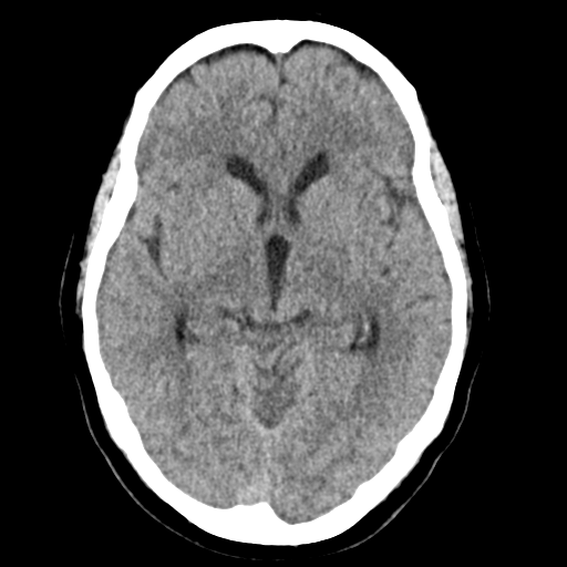 Cerebellar metastasis (Radiopaedia 54578-60812 Axial non-contrast 22).png