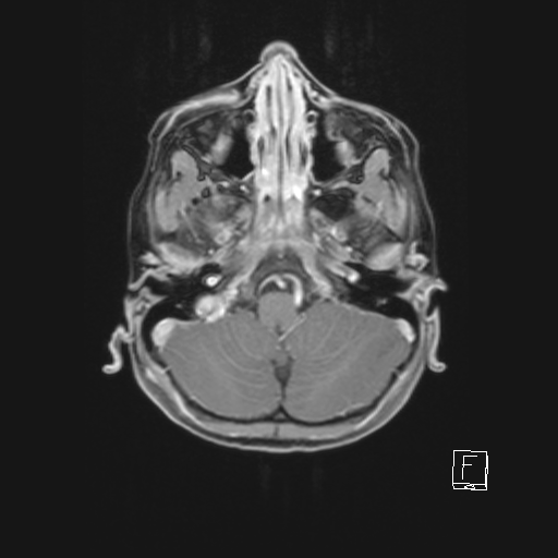 Cerebellar stroke (Radiopaedia 32202-33150 Axial T1 C+ 21).png