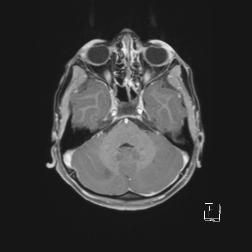 Cerebellar stroke (Radiopaedia 32202-33150 Axial T1 C+ 26).png