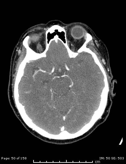 Cerebellar strokes due to intracranial giant cell arteritis (Radiopaedia 68799-78510 CT angiogram 50).jpg