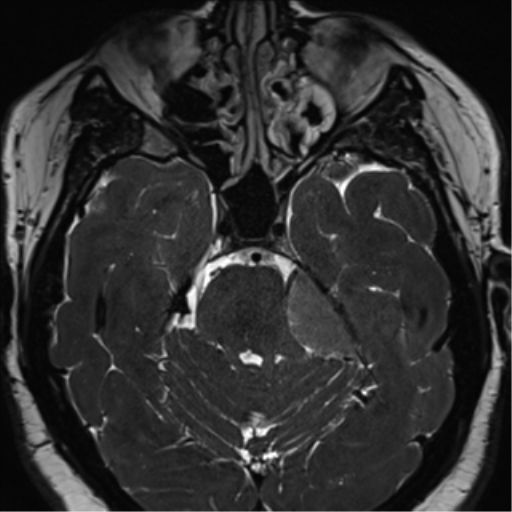 Cerebellopontine angle meningioma (Radiopaedia 48434-53348 Axial T2 Space 74).png