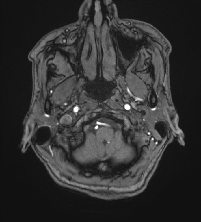 Cerebellopontine angle meningioma (Radiopaedia 72983-83680 Axial MRA 3).jpg
