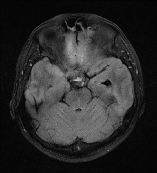 File:Cerebral abscess (Radiopaedia 24212-24478 Axial FLAIR 8).jpg