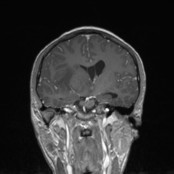 Cerebral abscess (Radiopaedia 24212-24478 Coronal T1 C+ 108).jpg