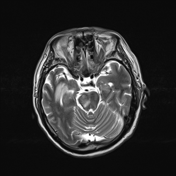 Cerebral abscess (Radiopaedia 26111-26247 Axial T2 25).jpg