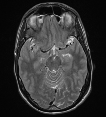 File:Cerebral abscess (Radiopaedia 60342-68009 Axial T2 13).png