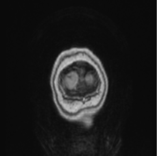 Cerebral abscess from pulmonary arteriovenous malformation (Radiopaedia 86275-102291 L 5).png