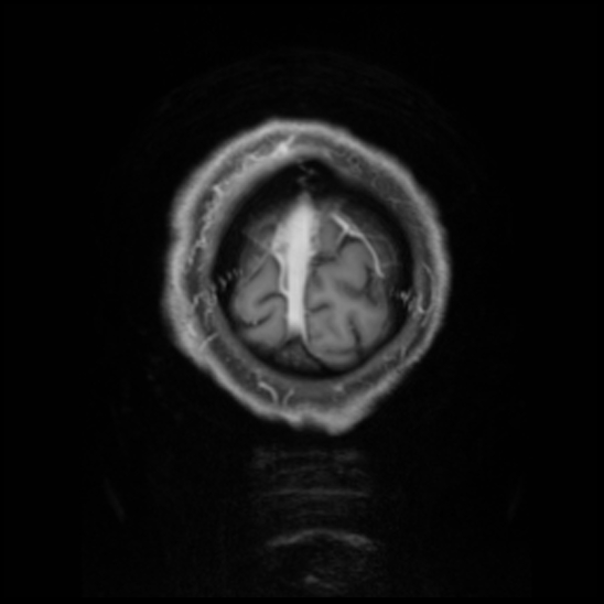 Cerebral abscess with ventriculitis (Radiopaedia 78965-91878 Coronal T1 C+ 62).jpg