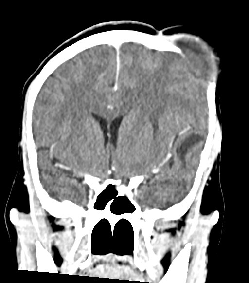 Cerebral abscesses (Radiopaedia 70458-80568 Coronal Contrast 27).jpg
