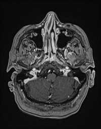 Cerebral amyloid angiopathy-related inflammation (Radiopaedia 58270-65377 Axial T1 C+ fat sat 12).jpg