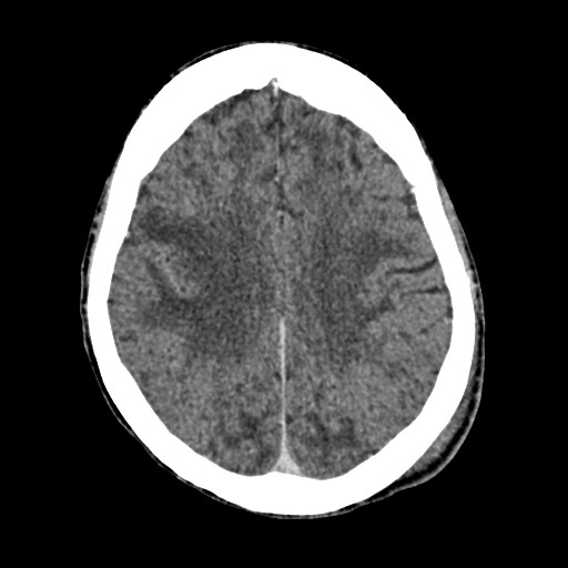 Cerebral amyloid angiopathy-related inflammation (Radiopaedia 74836-85848 Axial non-contrast 42).jpg