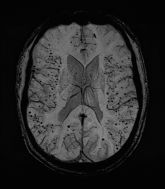 Cerebral amyloid angiopathy (Radiopaedia 46082-50433 Axial SWI MIP 45).png