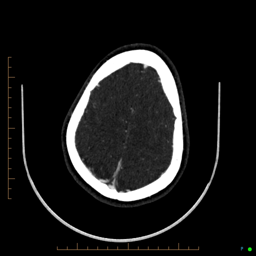 Cerebral arteriovenous malformation (AVM) (Radiopaedia 78162-90706 Axial CTA 224).jpg