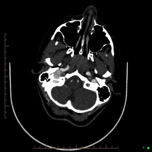 Cerebral arteriovenous malformation (AVM) (Radiopaedia 78162-90706 Axial CTA 57).jpg