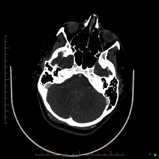 Cerebral arteriovenous malformation (AVM) (Radiopaedia 78162-90706 Axial CTA 80).jpg