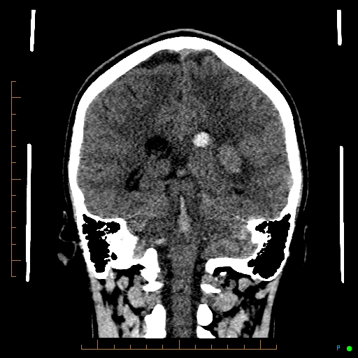 File:Cerebral arteriovenous malformation (AVM) (Radiopaedia 78162-90706 Coronal non-contrast 63).jpg