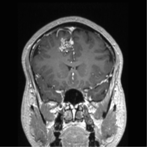 Cerebral arteriovenous malformation (Radiopaedia 39259-41506 Coronal T1 C+ 64).png