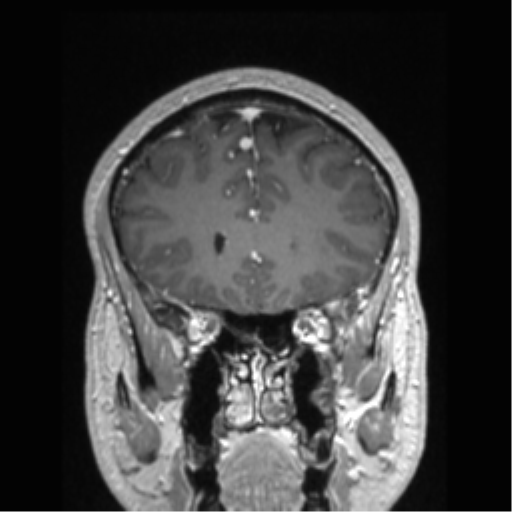 Cerebral arteriovenous malformation (Radiopaedia 39259-41506 Coronal T1 C+ 69).png