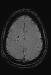 File:Cerebral arteriovenous malformation (Radiopaedia 55798-62372 Axial SWI 33).png
