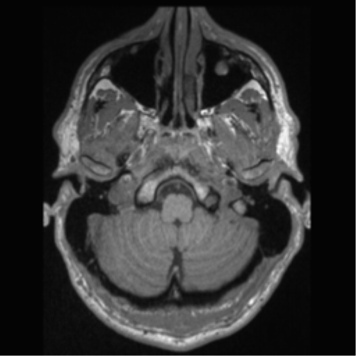 Cerebral arteriovenous malformation (Radiopaedia 55798-62372 Axial T1 6).png