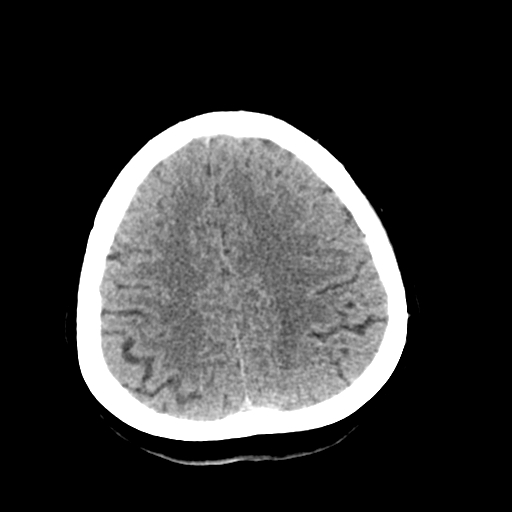 File:Cerebral arteriovenous malformation (Radiopaedia 73830-84645 Axial non-contrast 36).jpg